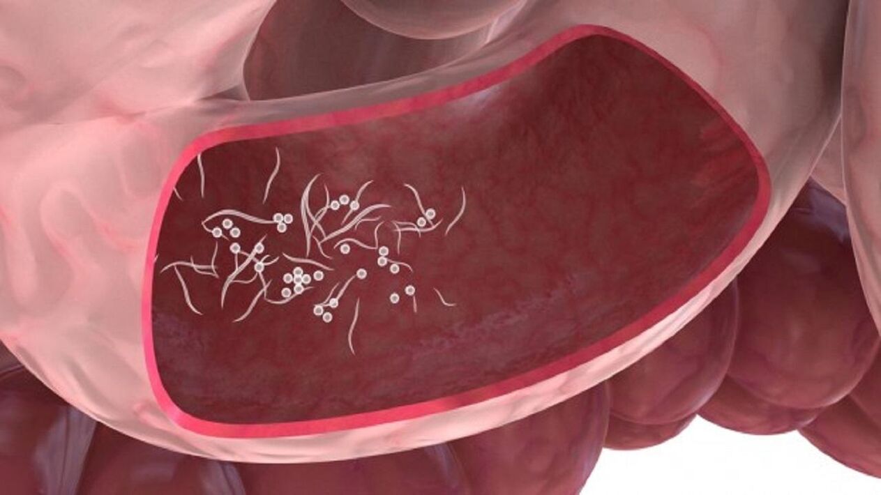 طفيليات الجيارديا في الكبد